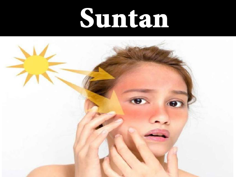 Suntan