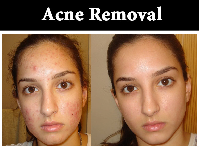 acne-removal