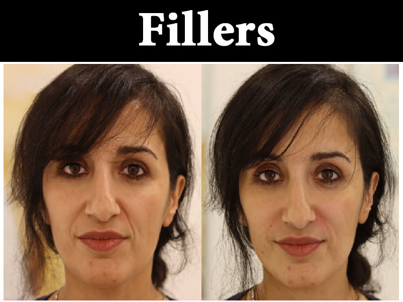 skin-treatment5